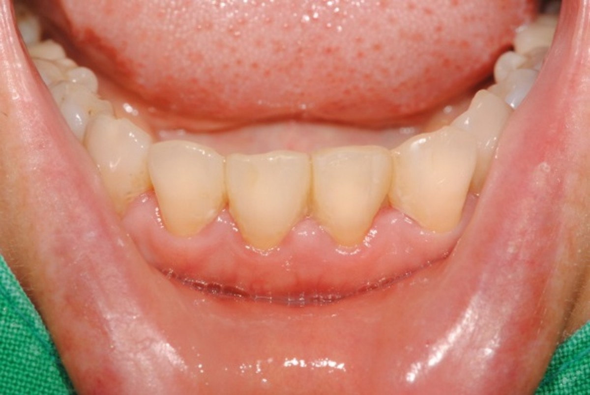 Lower anterior teeth showed periodintal inflammation.