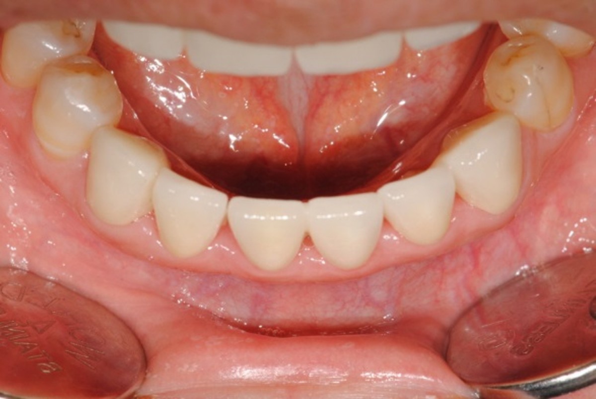 Lower anterior restoration