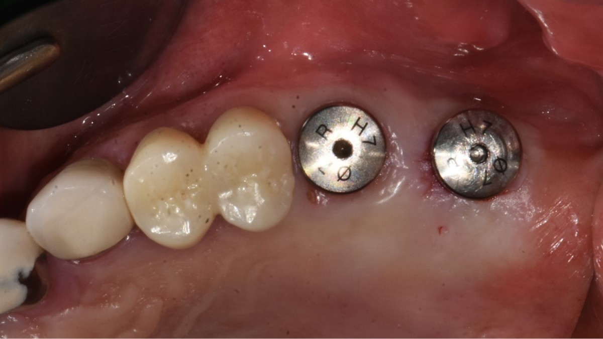 photo after implant uncovery.