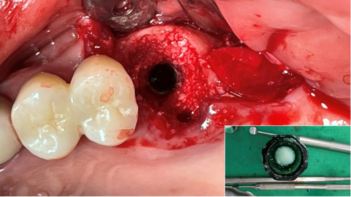 Photo after carefully pulling out the direction pin after GBR.