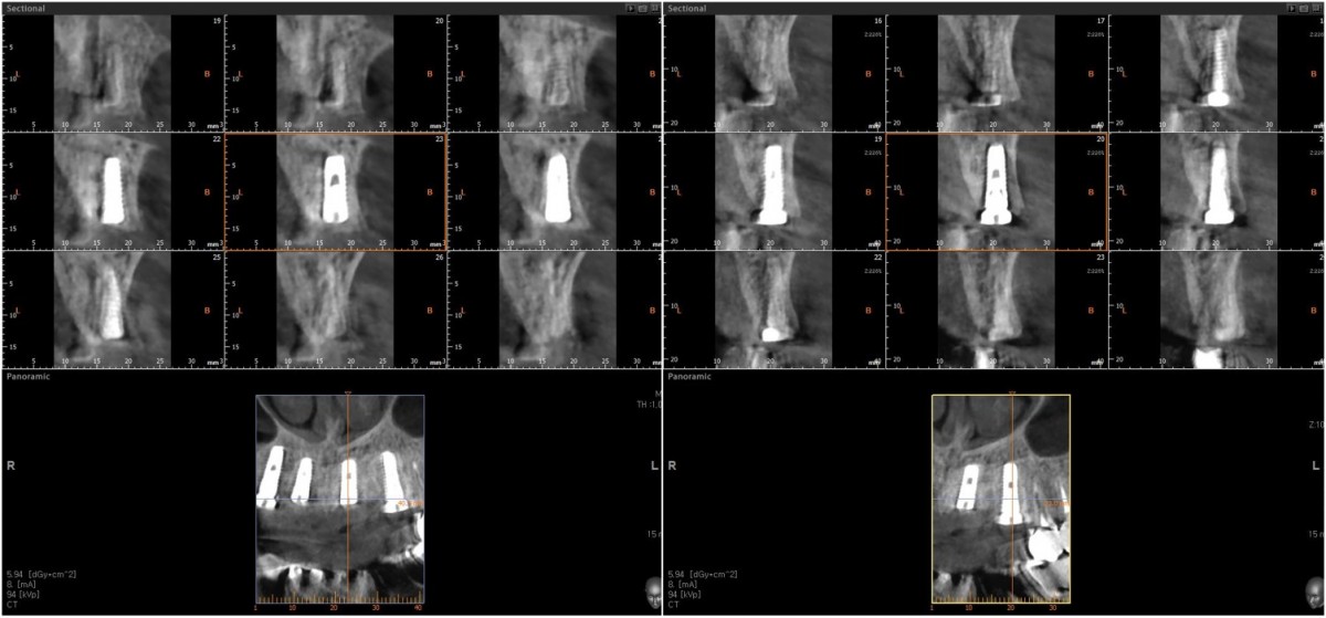 CBCT scan image focused on the central incisor and canine on the left side.