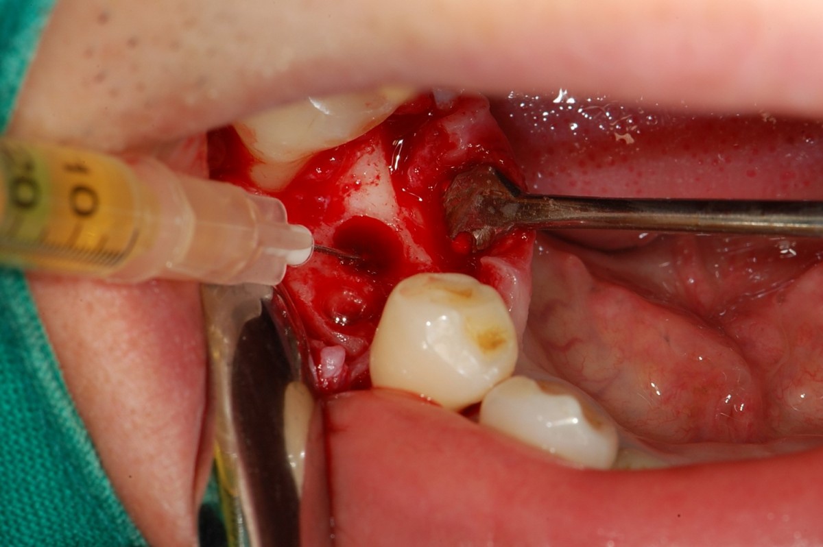 An implant was placed