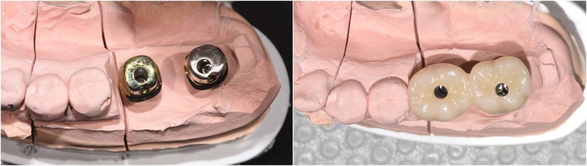 Custom abutment and crown on the mandibular working model.