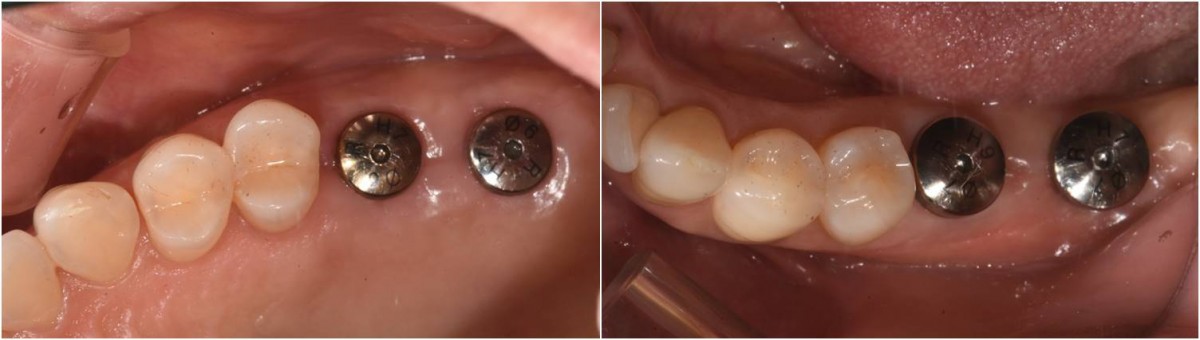 Intraoral photo on the day of the ISQ reading in the maxilla.