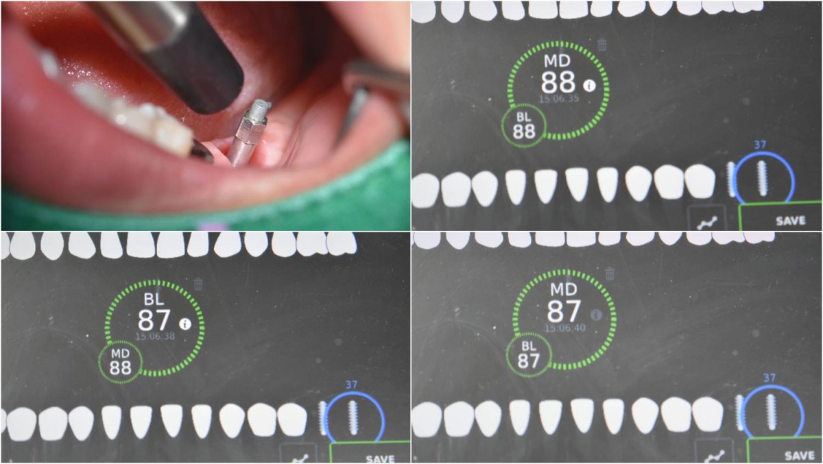  ISQ reading at the first molar zone.