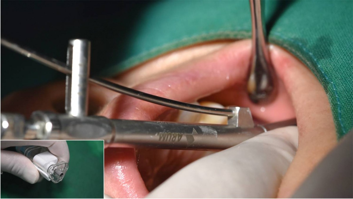 Arum Dentistry NB1 5*11.5 (30Ncm) at the first molar zone.