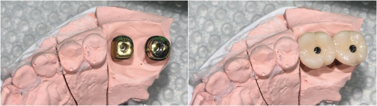 Custom abutment and crown on the maxillary working model.