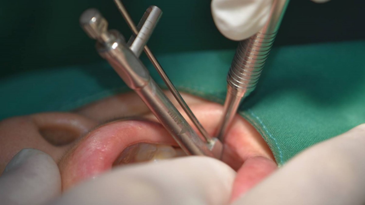 Arum Dentistry NB1 5*11.5 (15Ncm) at the second molar zone