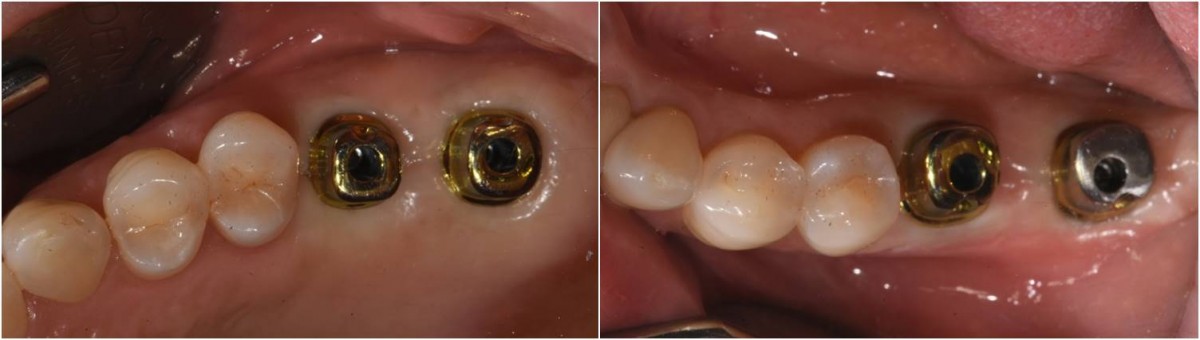 Abutment connection.