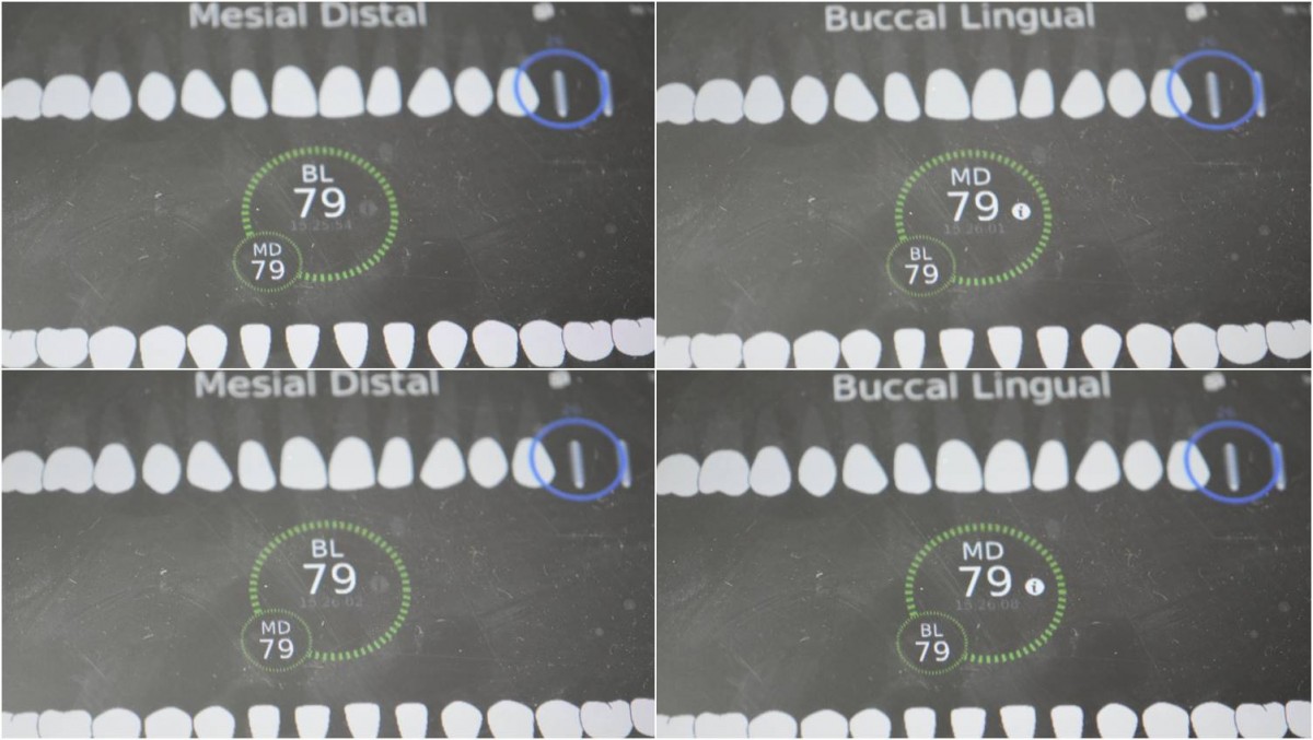 ISQ reading at the first molar zone of the maxilla.