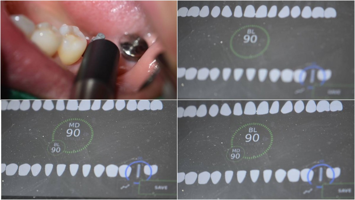 ISQ reading at the first molar zone.