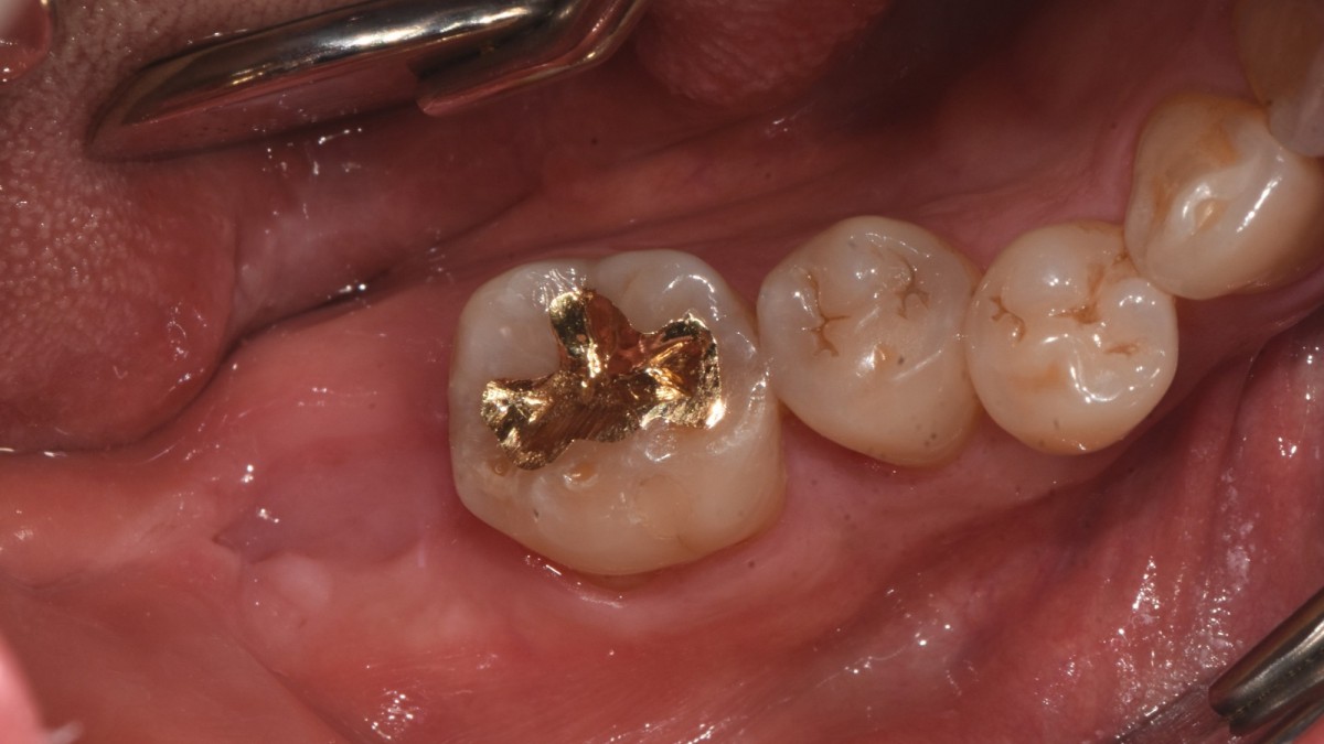 2 months after the extraction