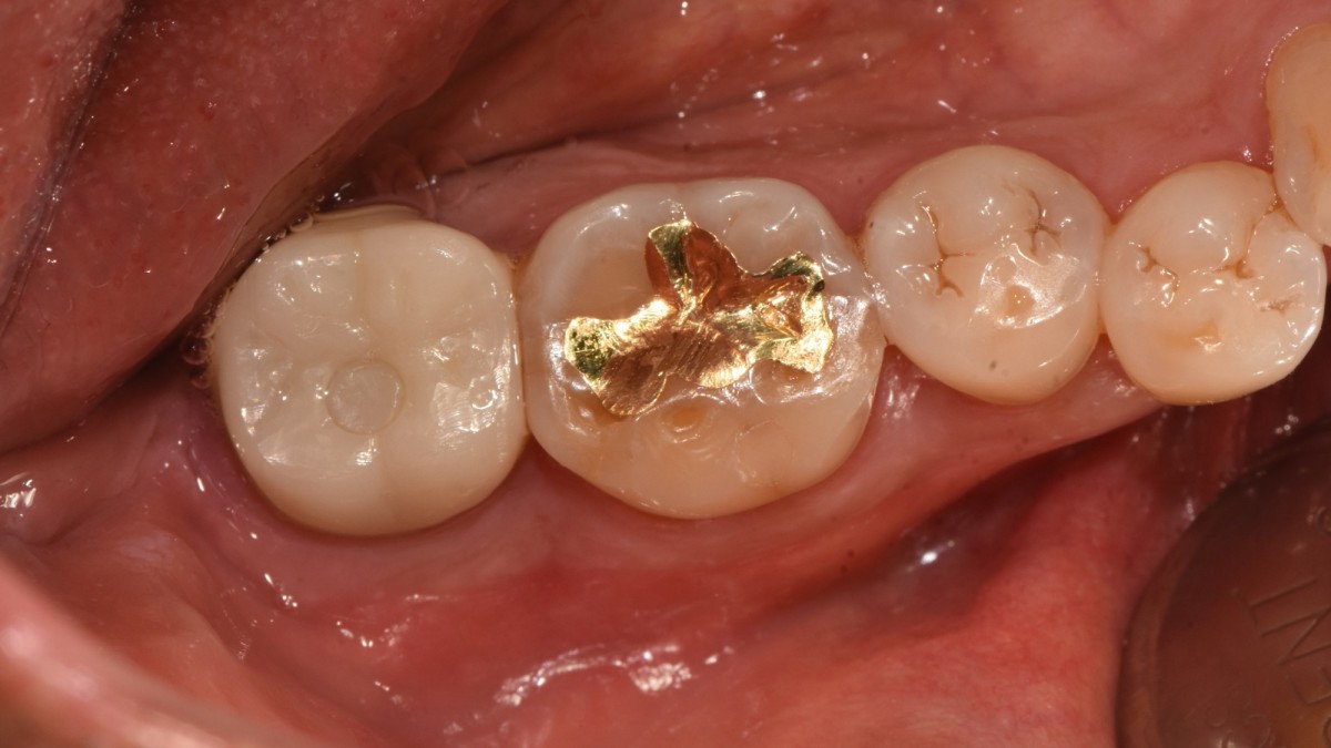  41 months after loading