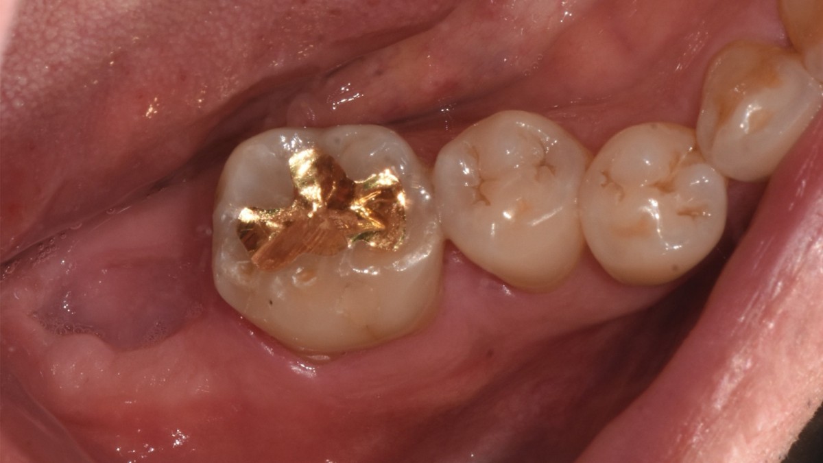 i month after the extraction