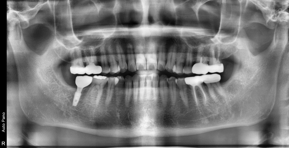 panorama ; 41 months after loading