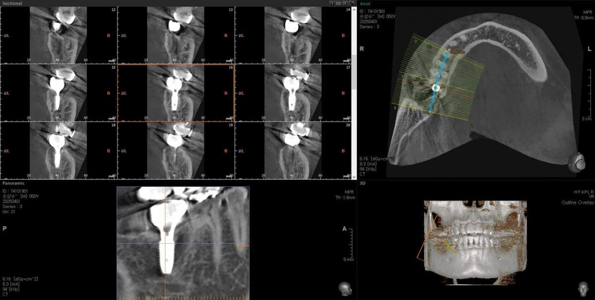 CBCT ; 41 months after loading