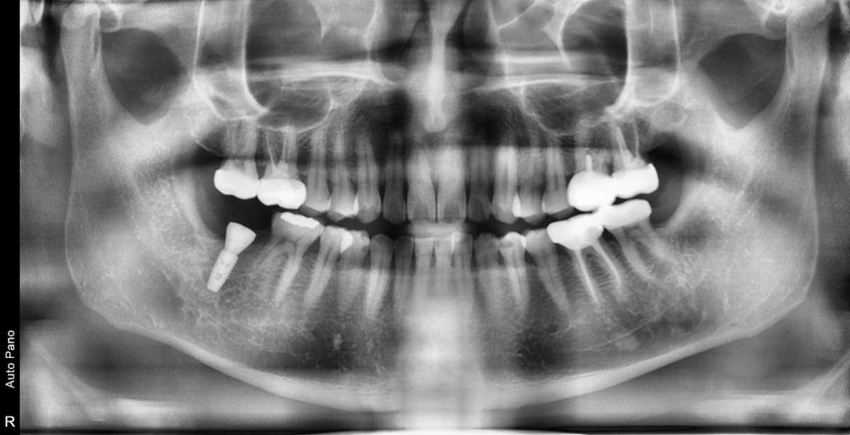 panoramic radiograph