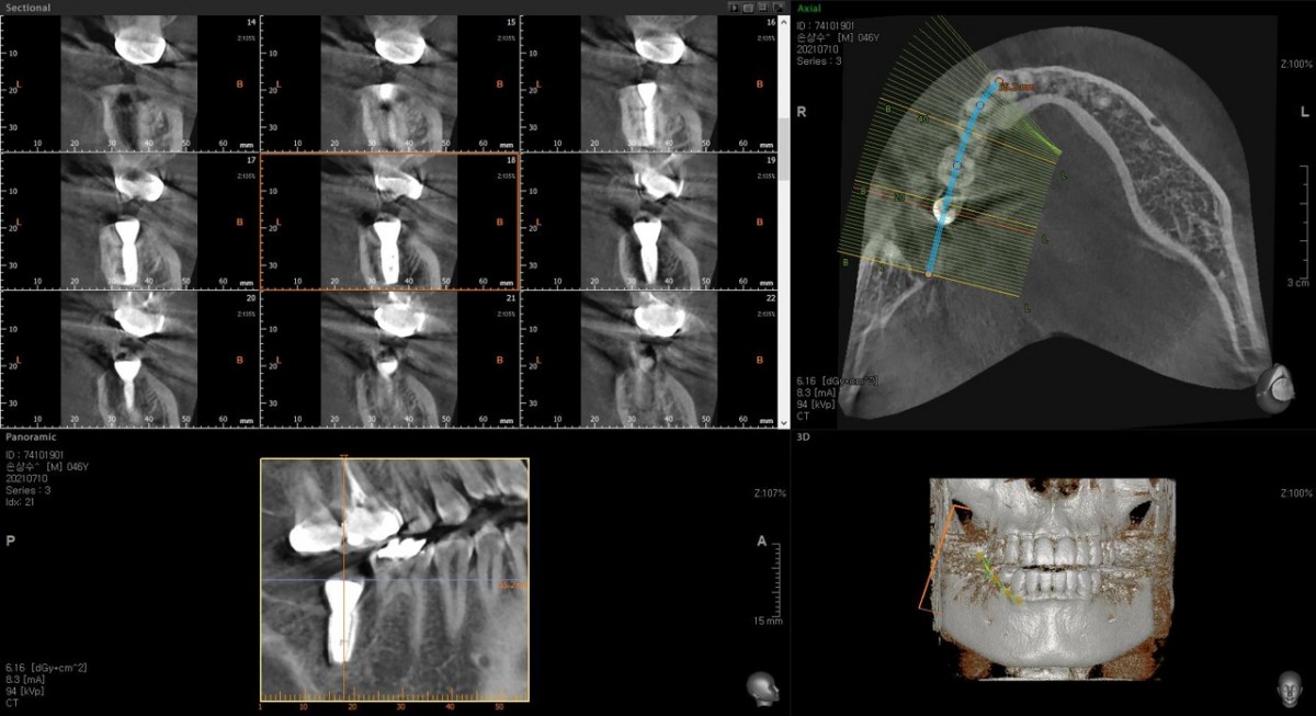 CBCT