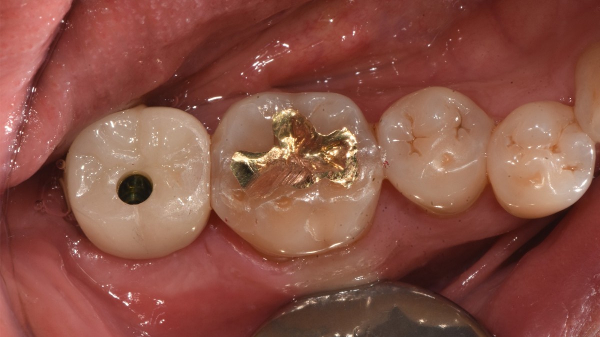 crown seating trial after Abt connection