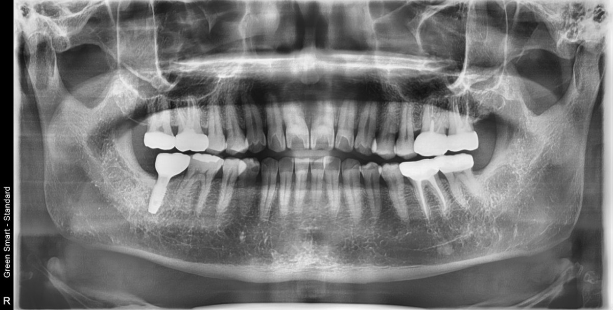 panorama rightafter crown cementation.