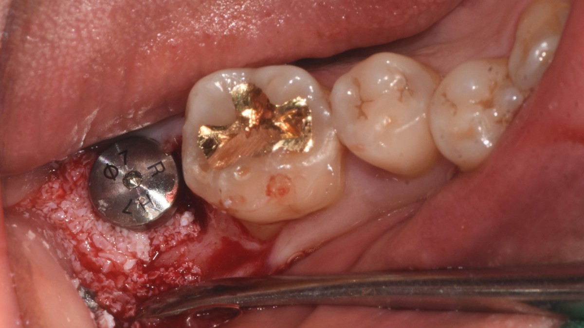 GBR was performed -Xenograft