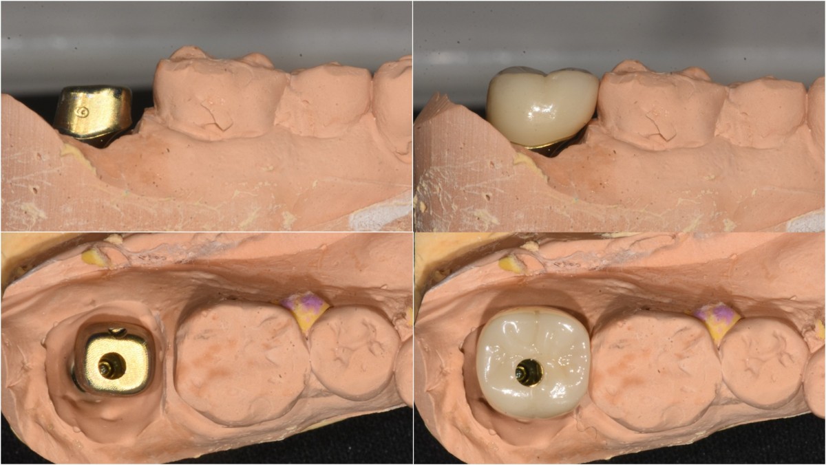 custom abutment and zirconia crown.