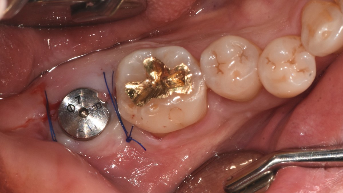 The flap was trimmed and closed.