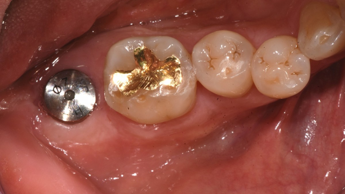 3 months post op. photo on the day of ISQ reading and impression taking.